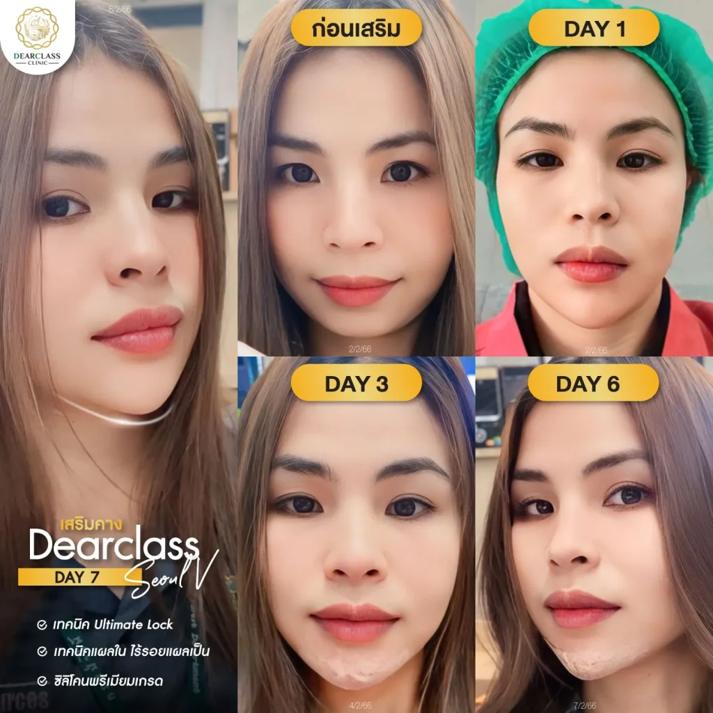 เสริมคาง Dearclass-03
