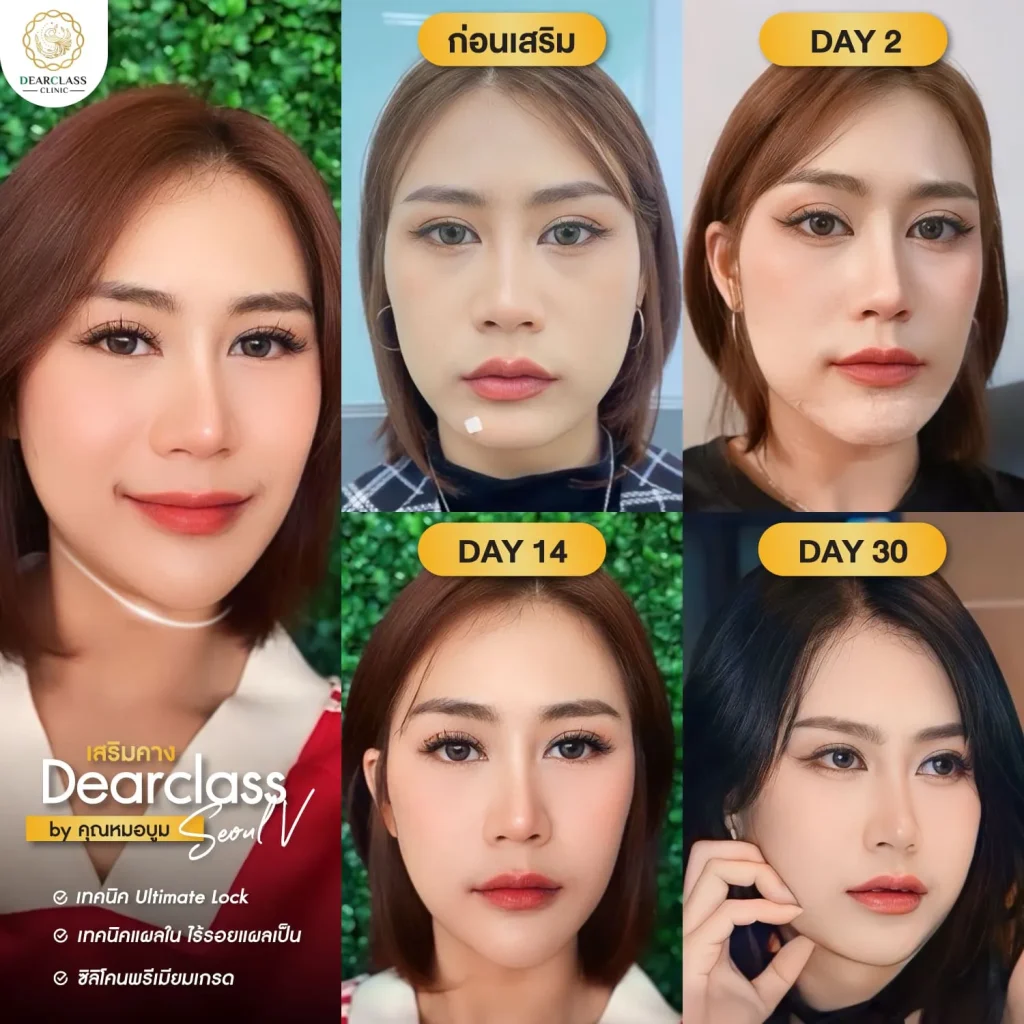 เสริมคาง Dearclass-09